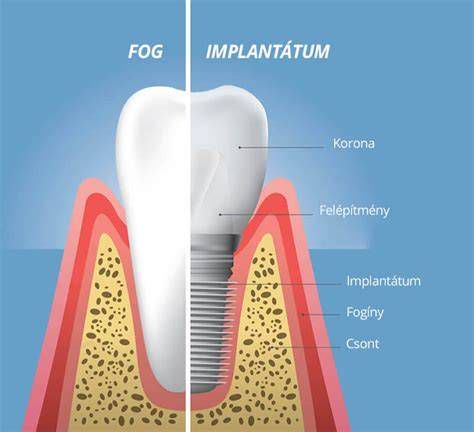 A fogászati implantátum felépítése és anatómiája