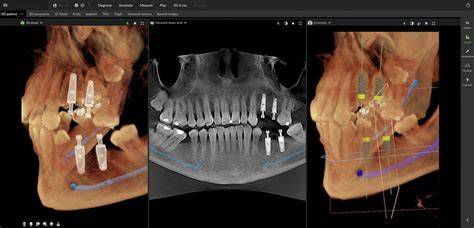 CT felvétel a fogászati implantáció tervezéséhez