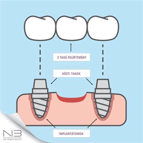 A fogászati implantátum felépítményének típusai